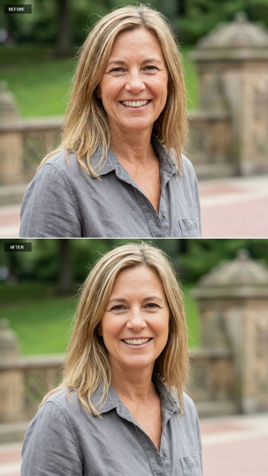 Non-Surgical Nose Job - Filler