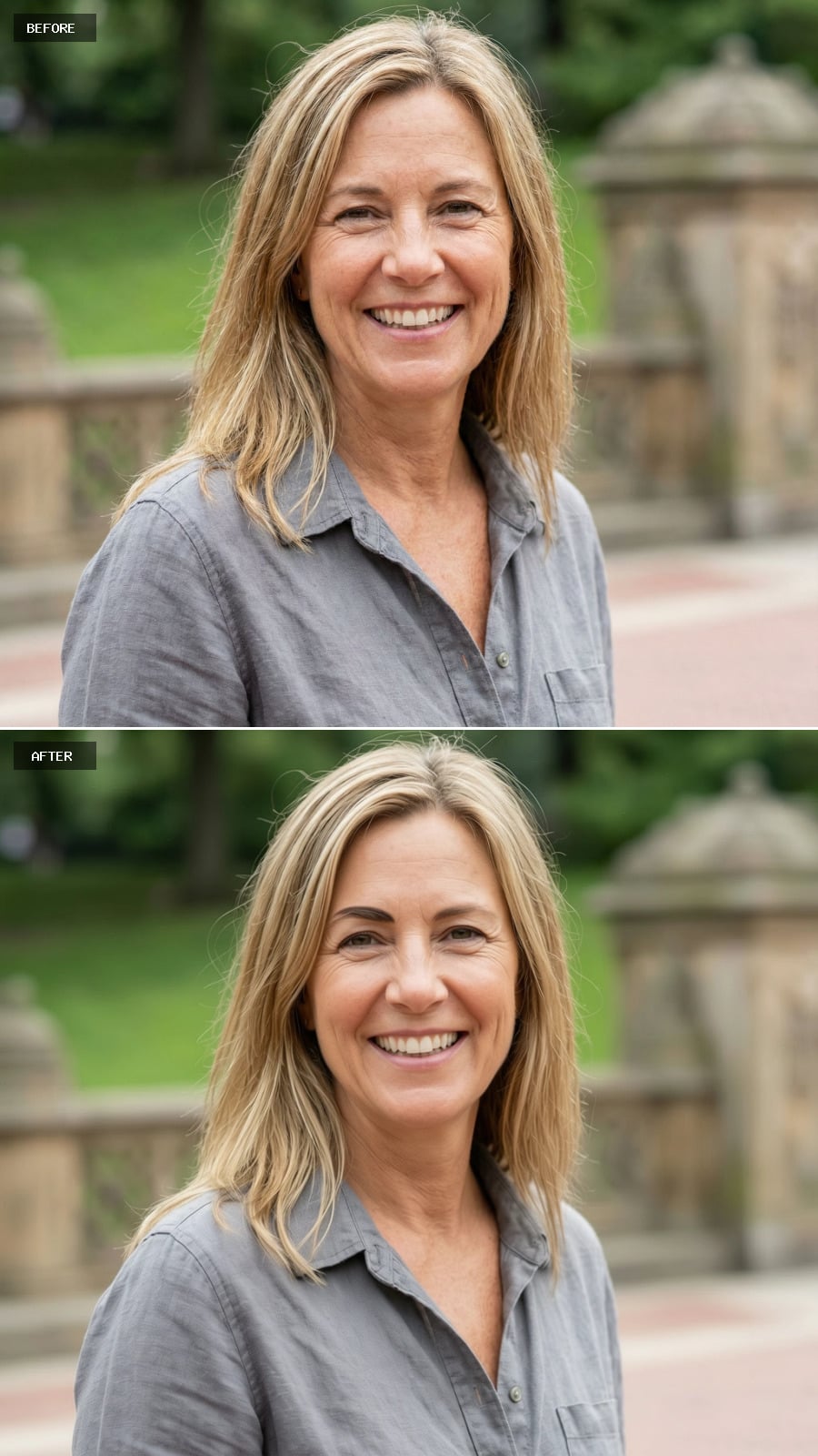 Brow Lift - Subtle Elevation