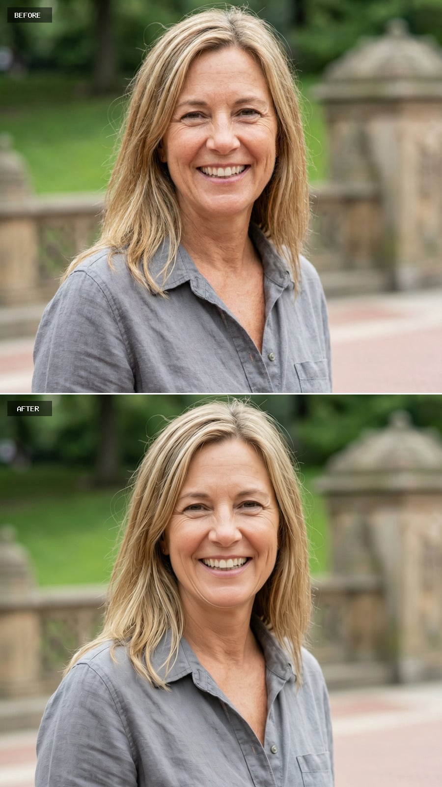 Jawline Filler - Defined Jaw