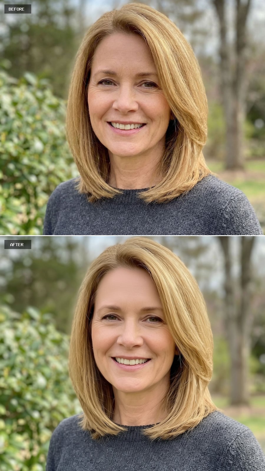 Smooth Forehead - Line Removal