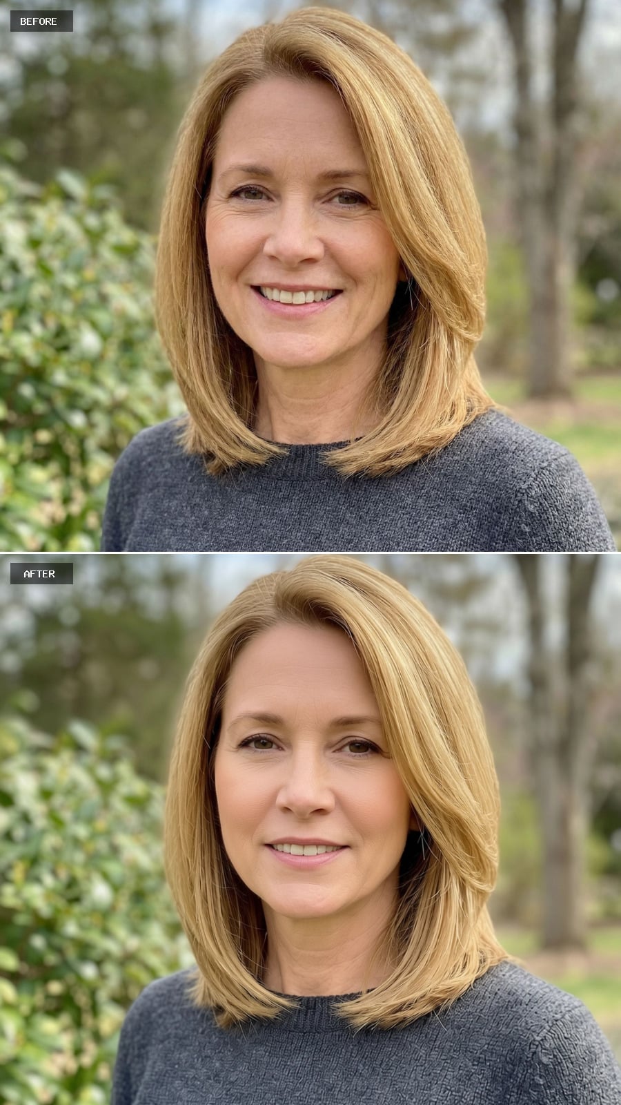 Smooth Glabella - No Frown Lines