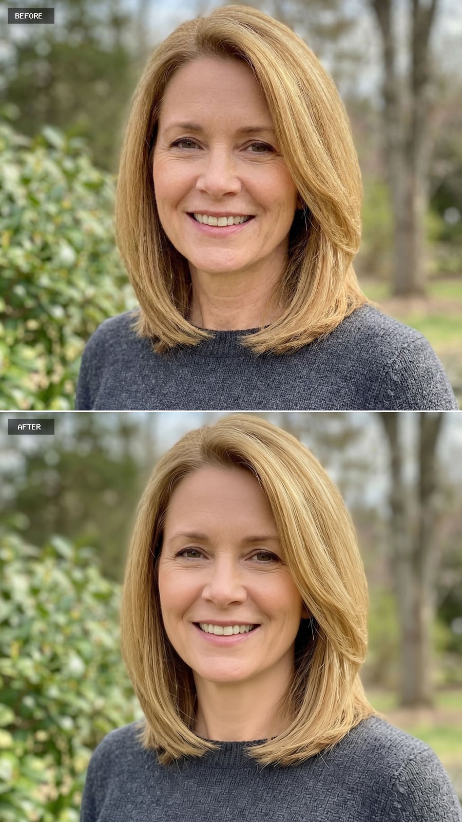 Jawline Enhancement - Defined Angle