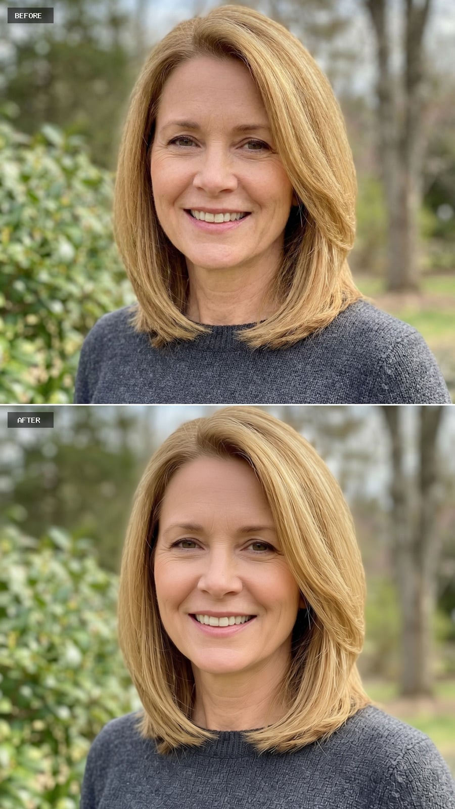 Rhinoplasty - Refined Nasal Tip