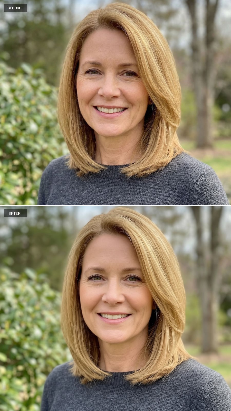 Full Eye Rejuvenation - Upper and Lower