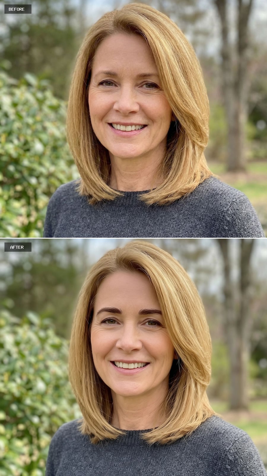 Brow Rejuvenation - Natural Lift